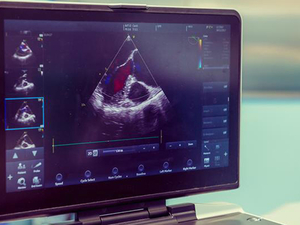 A medical monitor displays a heart ultrasound (echocardiogram) with a grayscale image of the heart and colored Doppler flow indicating blood movement. The screen includes smaller preview images on the left and control settings along the bottom and right side, suggesting the scan is being actively analyzed in a clinical setting.