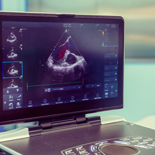 The visual display of a cardiac sonography read out during an examination.